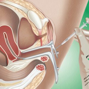 تزریق اسپرم داخل رحم (IUI)