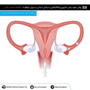 IUI آی یو آِی