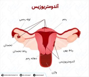 درمان نازایی